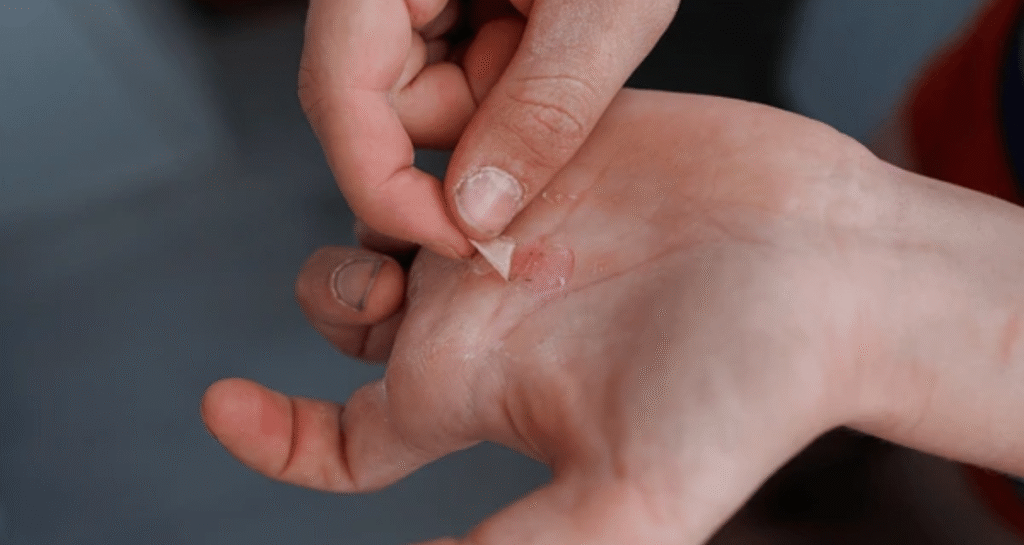 Torn callus on palm being treated with RIPT kit healing balm for fast recovery