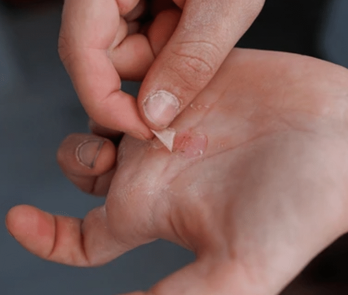Torn callus on palm being treated with RIPT kit healing balm for fast recovery