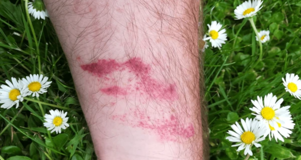 Red skin reaction on hairy leg resting on grass with white daisy flowers