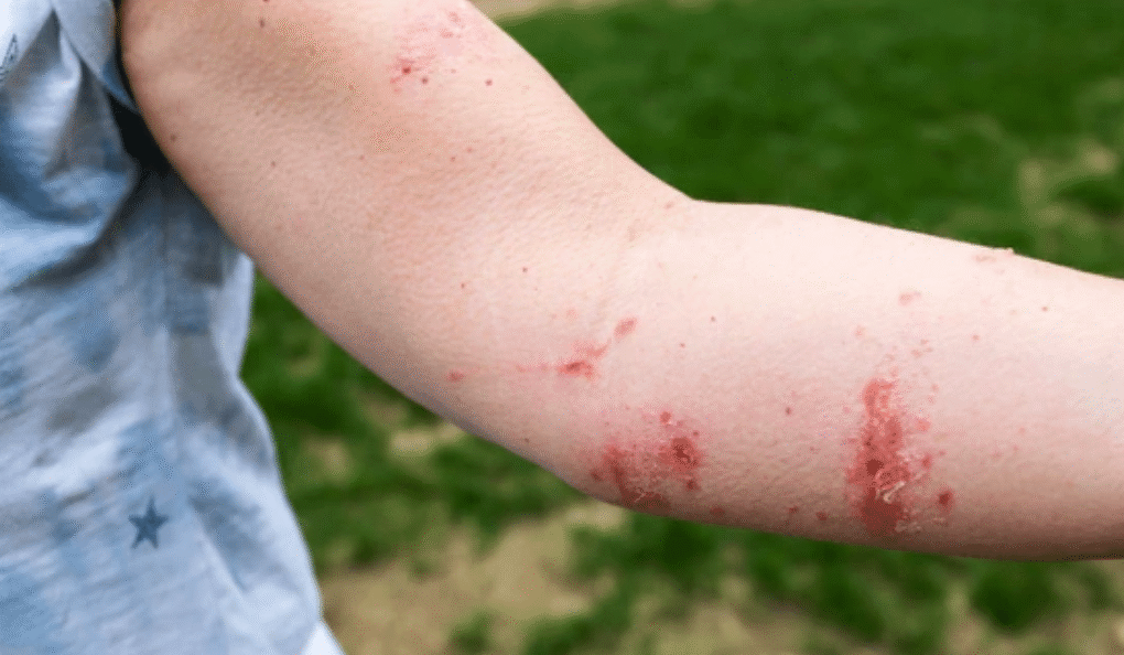 Close-up of red irritated rash on person's arm showing skin reactions caused by contact with poisonous plants