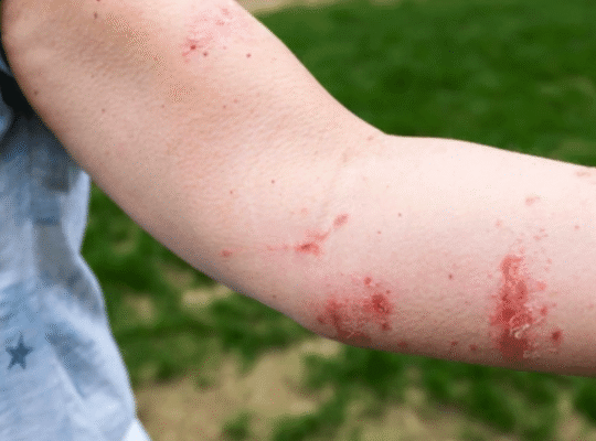Close-up of red irritated rash on person's arm showing skin reactions caused by contact with poisonous plants