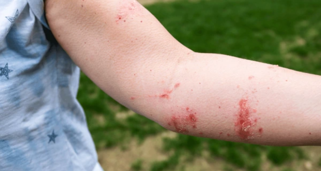 Close-up of red irritated rash on person's arm showing skin reactions caused by contact with poisonous plants